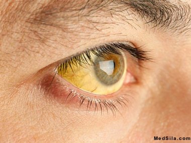 Желтушное окрашивание глаз